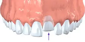 dislodge teeth
